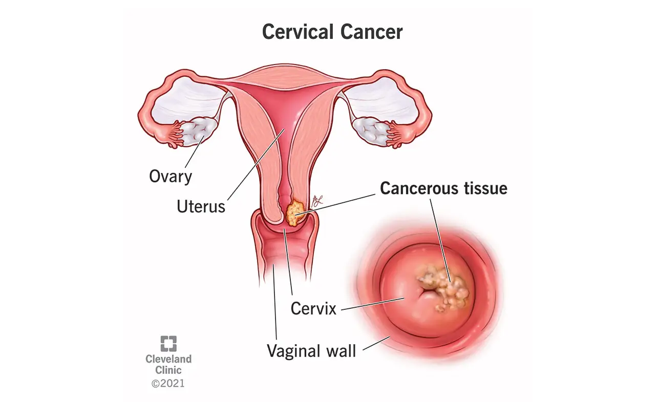 Cervical Cancer Life Expectancy