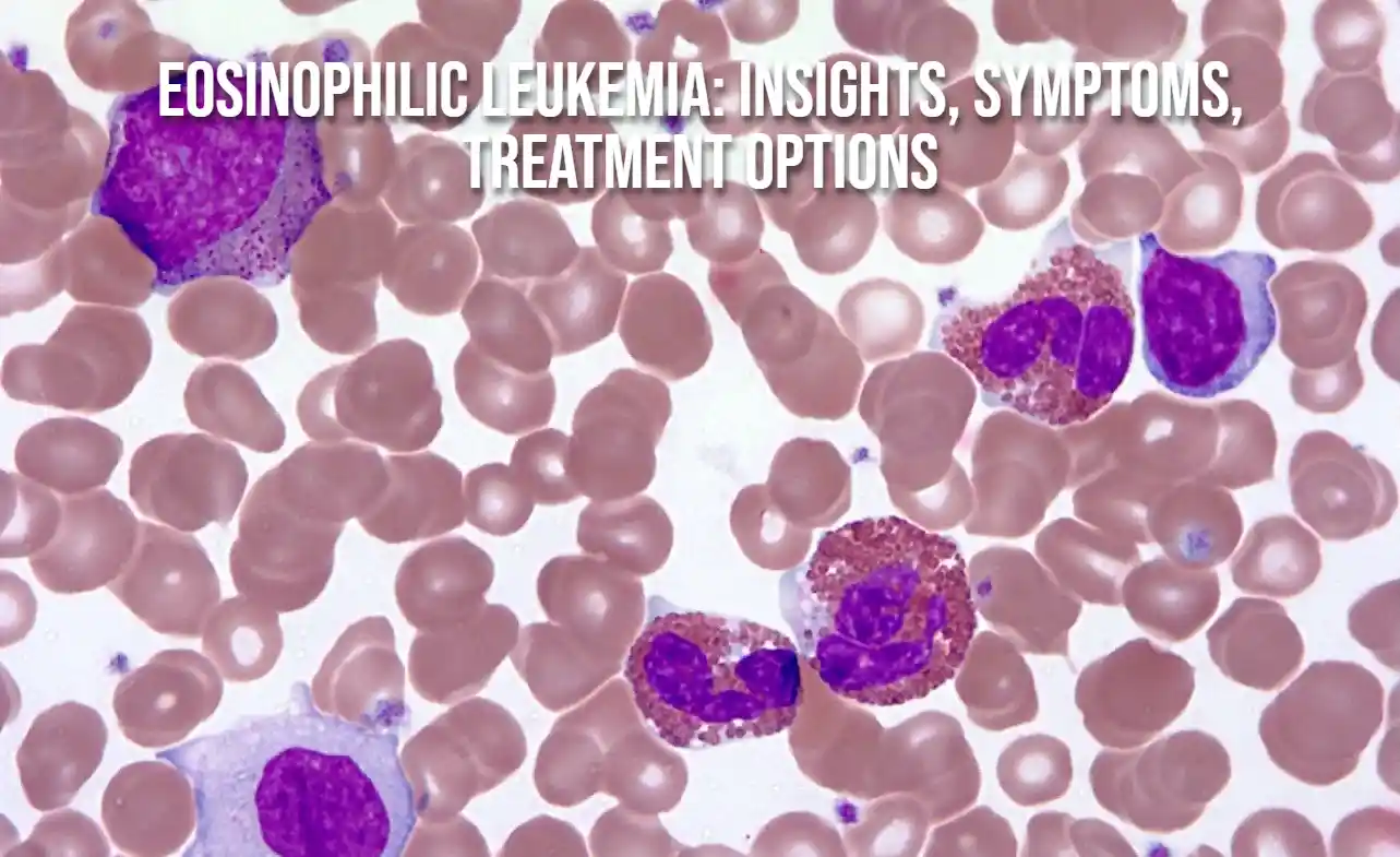 Eosinophilic Leukemia: Insights, Symptoms, Treatment Options