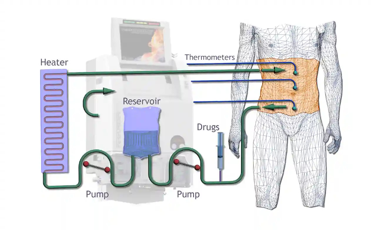 HIPEC Treatment for Colorectal Cancer