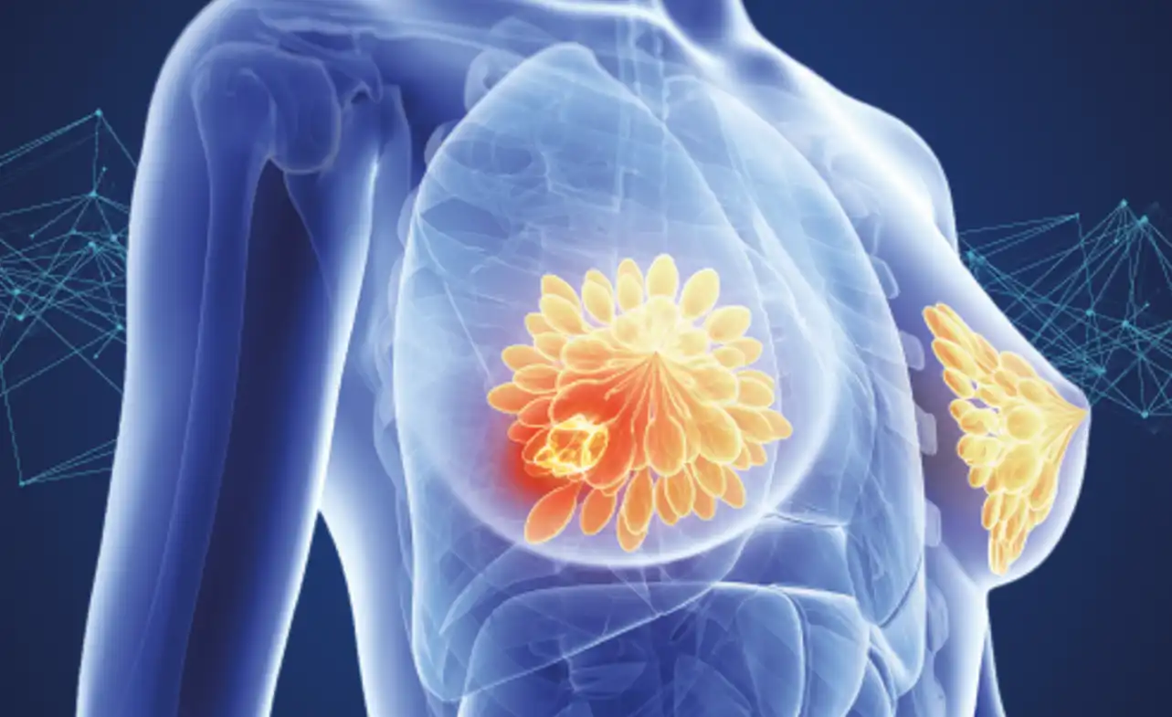 Inverted Nipple Breast Cancer