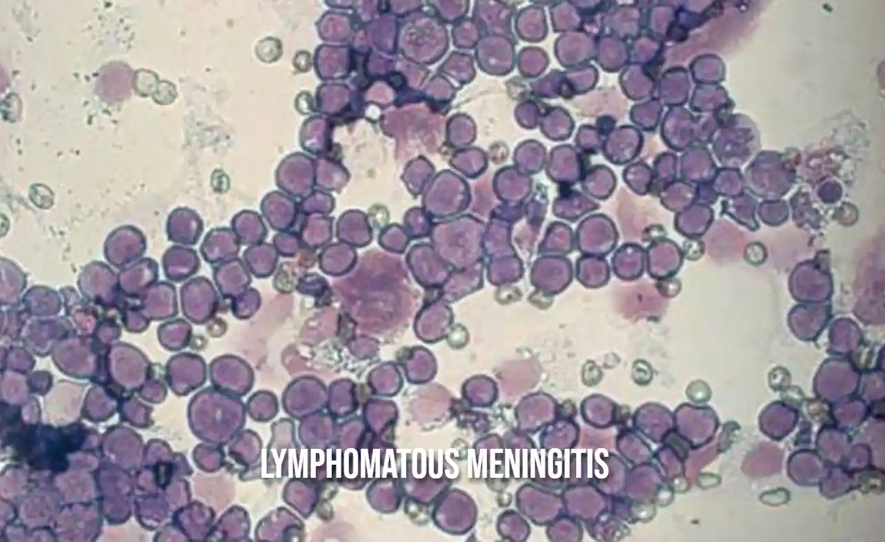 Lymphomatous Meningitis
