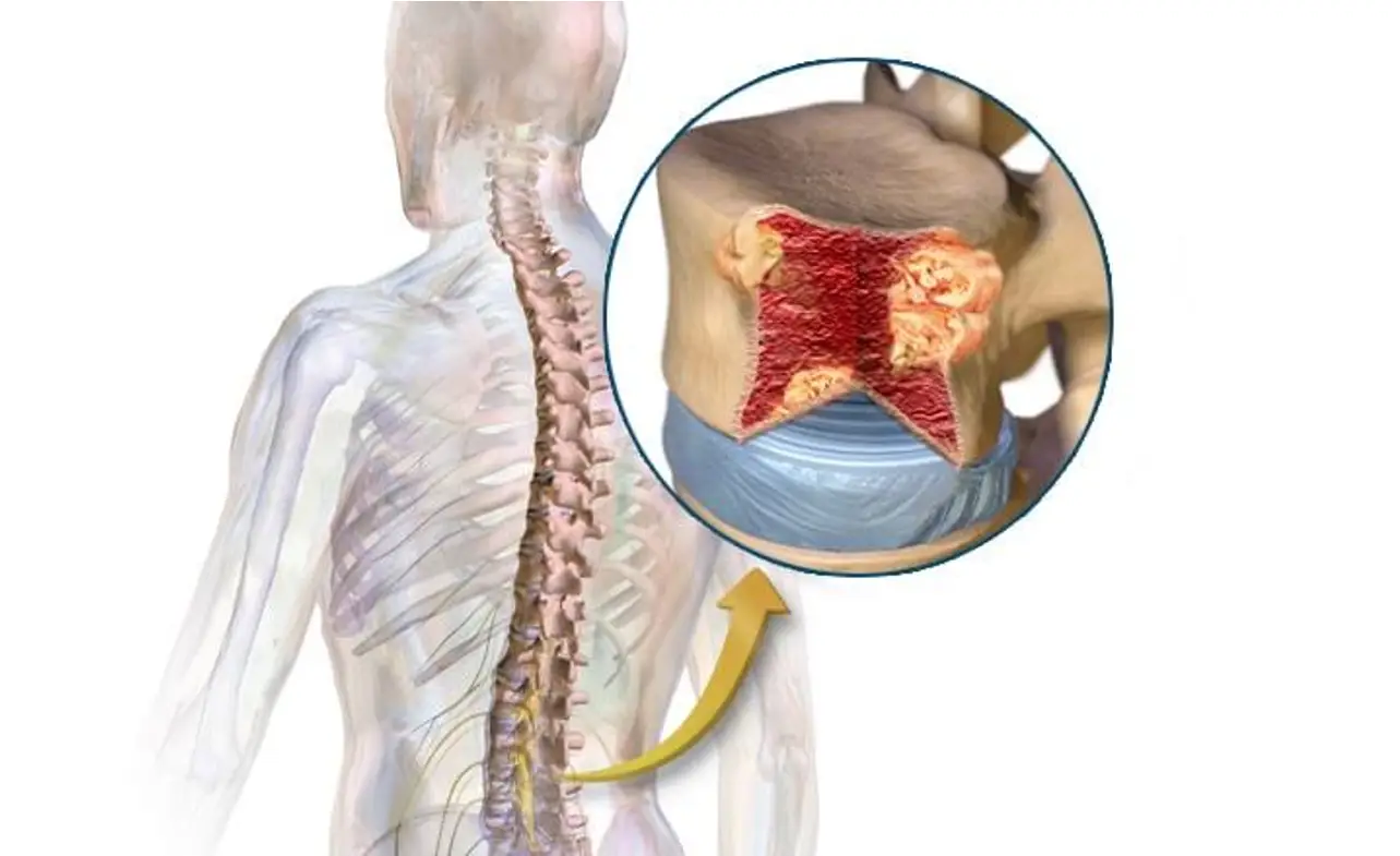 Multiple Myeloma Symptoms Rash: Early Detection is Key