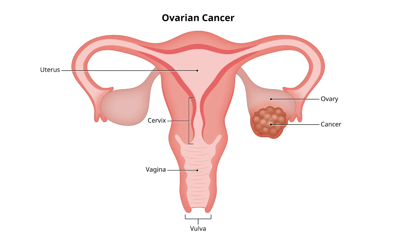Ovarian Cancer Surgery Cost Insights & Tips 2025