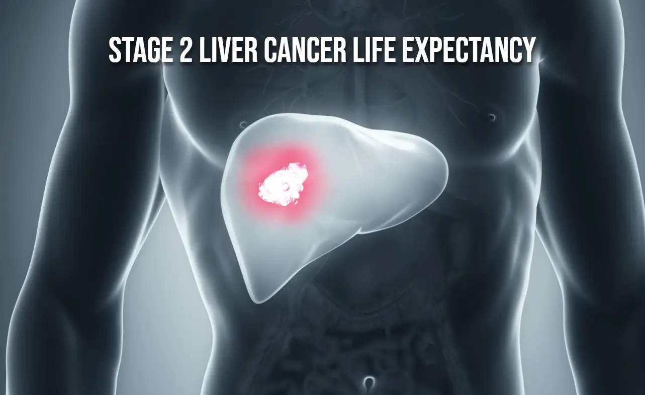 Stage 2 Liver Cancer Life Expectancy Insights 2025