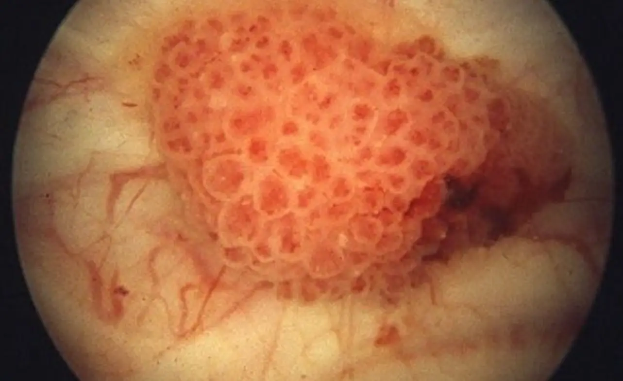 Stage 4 Bladder Cancer Life Expectancy