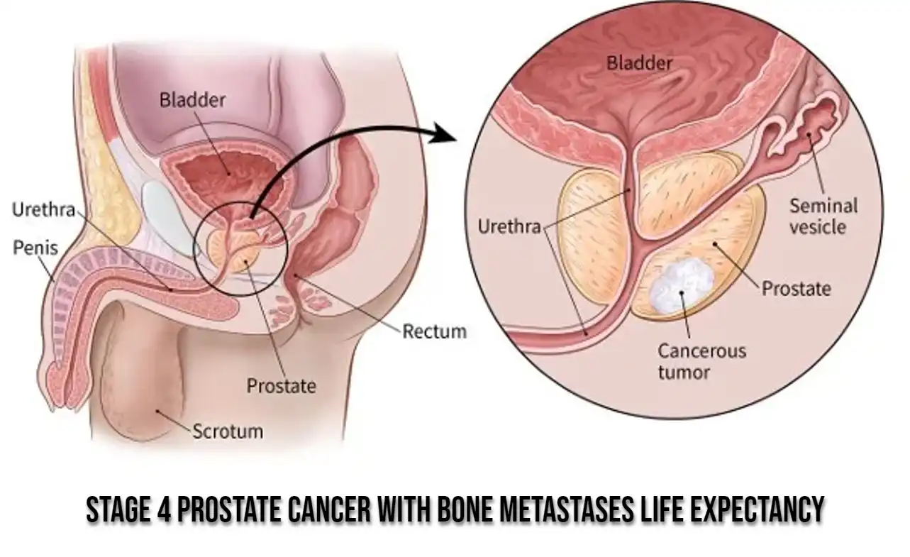 Stage 4 Prostate Cancer with Bone Metastases Life Expectancy