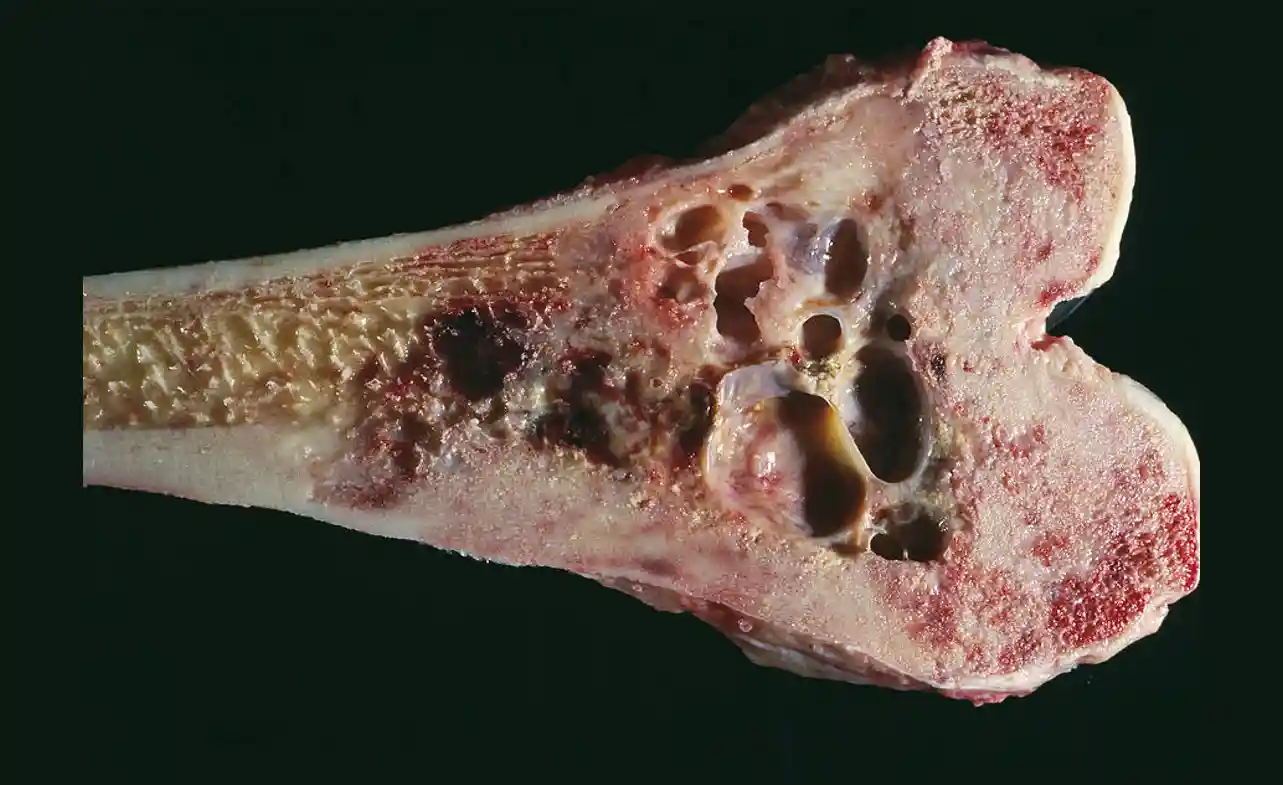 What is the Survival Rate of Stage 4 Bone Cancer 2025