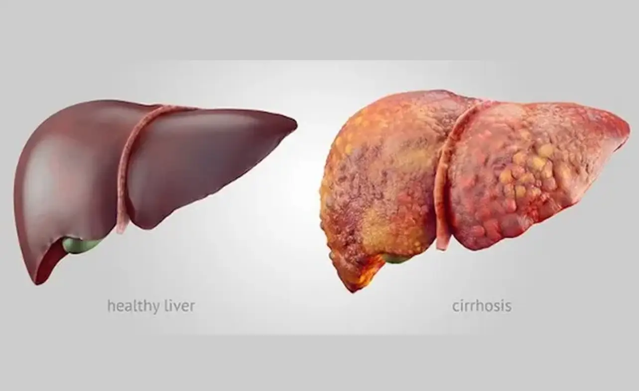 What is the Life Expectancy of Someone with Liver Cancer