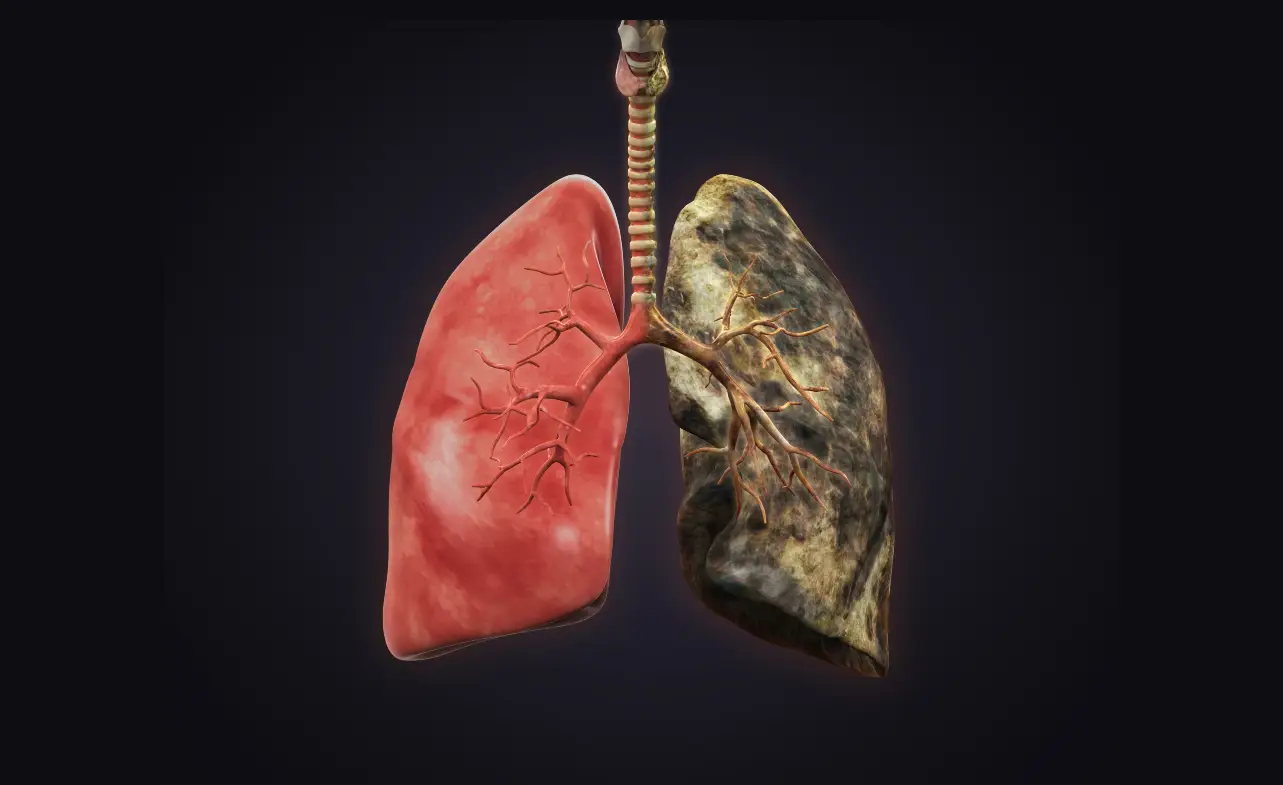 Inoperable Lung Cancer Life Expectancy – Understanding Your Prognosis