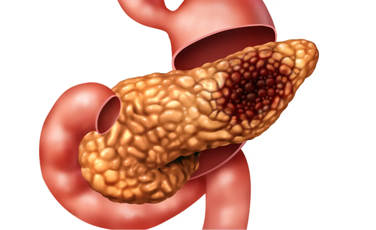pancreatic cancer ascites life expectancy
