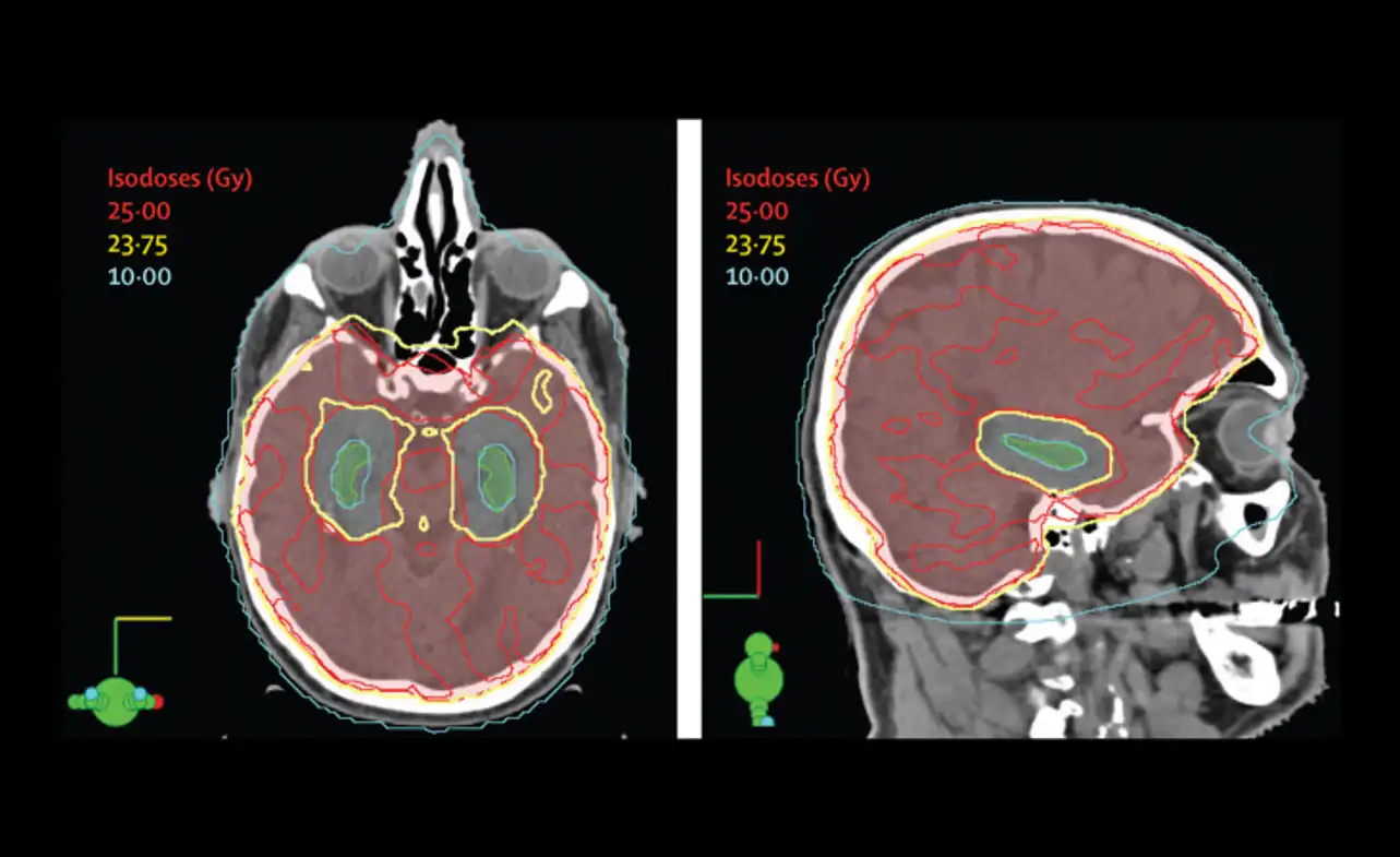 prophylactic cranial irradiation