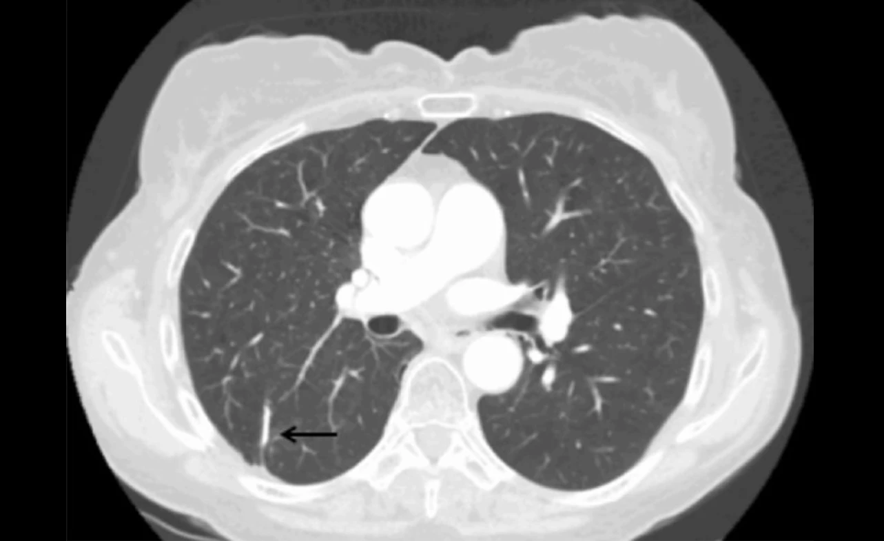 Recurrence of Lung Cancer After Lobectomy 2025