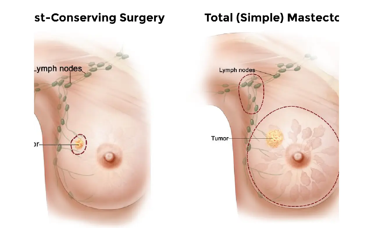 Treatment for Triple-Negative Breast Cancer: New Hope and Innovative Approaches