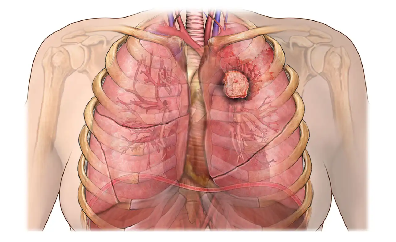 Understanding Neuroendocrine Carcinoid Lung Cancer: Symptoms, Diagnosis, and Treatment Options