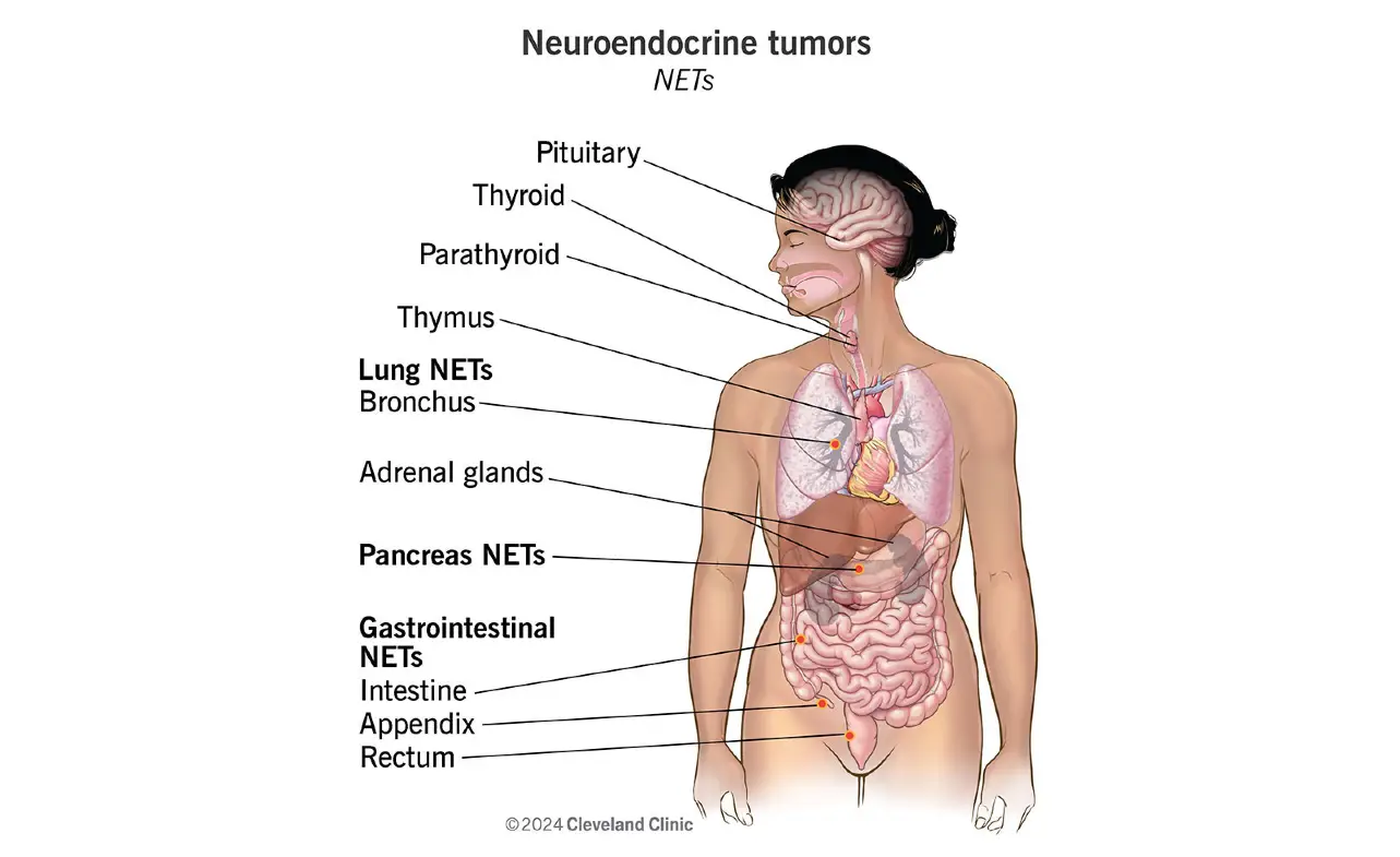 Neuroendocrine Carcinoma Cancer: Causes, Symptoms, and Treatment Options