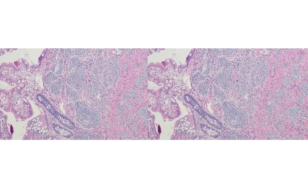 neuroendocrine carcinoid cancer