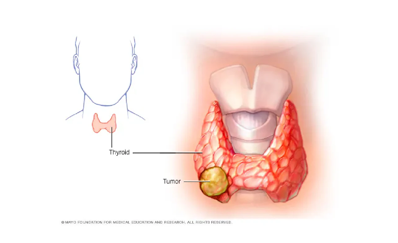 Thyroid Cancer Lump on Neck