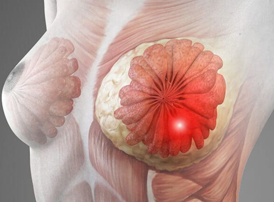 Breast Cancer Mets to Brain Prognosis: What You Need to Know