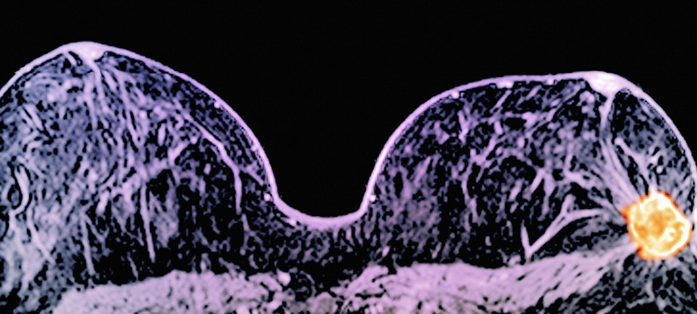 Breast Shrinking Cancer