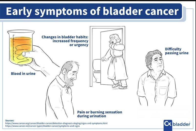 Early Symptoms of Bladder Cancer: Causes and Risk Factors