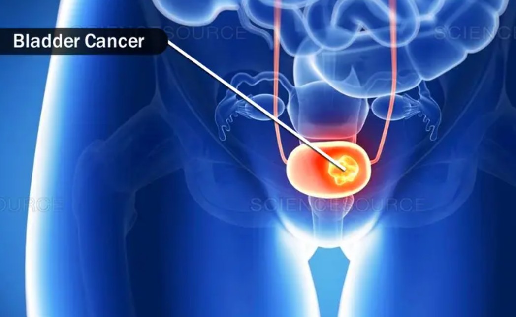 New Treatments for Bladder Cancer