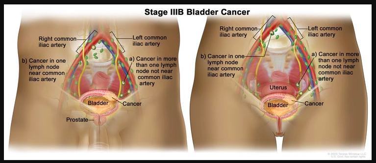 Bladder Cancer Symptoms in Women: Causes and Risk Factors