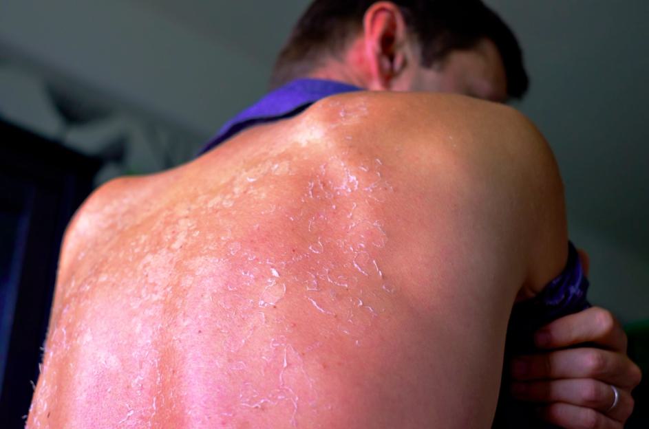 Can Skin Cancer Kill You? Causes and Risk Factors