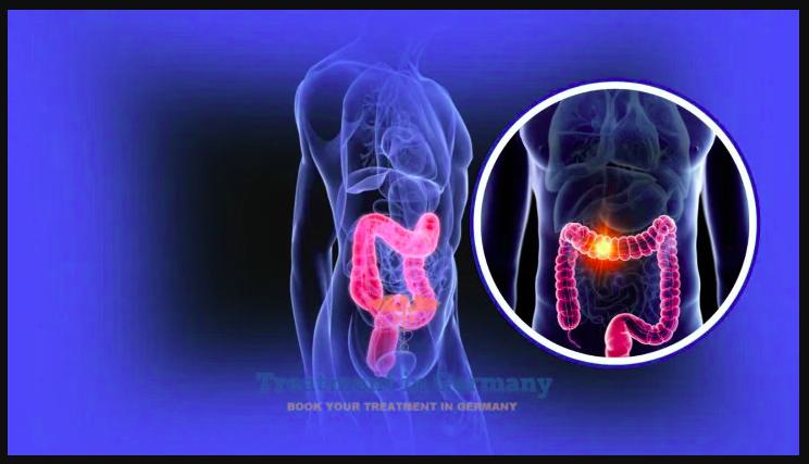 How Long Can You Live with Stage 4 Colon Cancer? Causes and Risk Factors