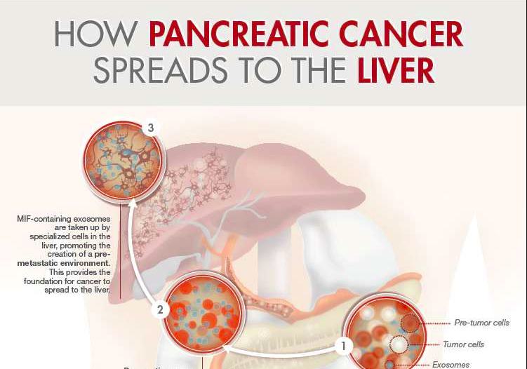 Pancreatic Cancer Spread to Liver: Causes and Risk Factors