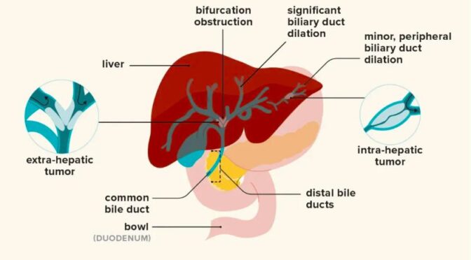 Bile Duct Cancer Stage 4: Causes and Risk Factors