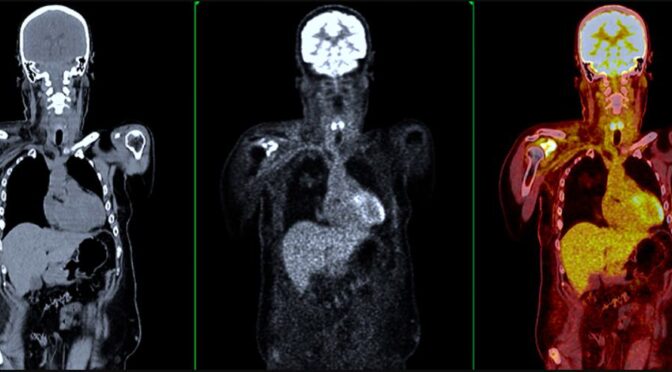 Bone Density Test for Cancer: Causes and Risk Factors