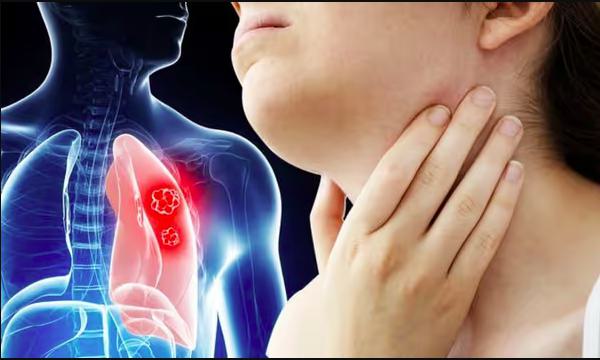 Cancer of the Lymph Nodes: Causes and Risk Factors