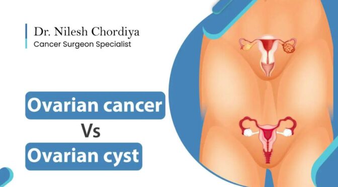 Difference Between Ovarian Cyst and Ovarian Cancer: Causes and Risk Factors