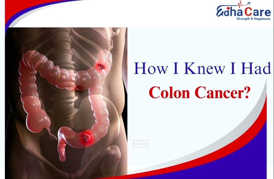 How I Knew I Had Colon Cancer: Causes and Risk Factors