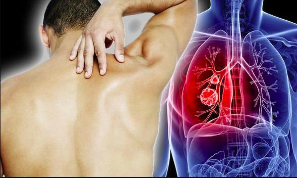 Lung Cancer and Back Pain: Causes and Risk Factors