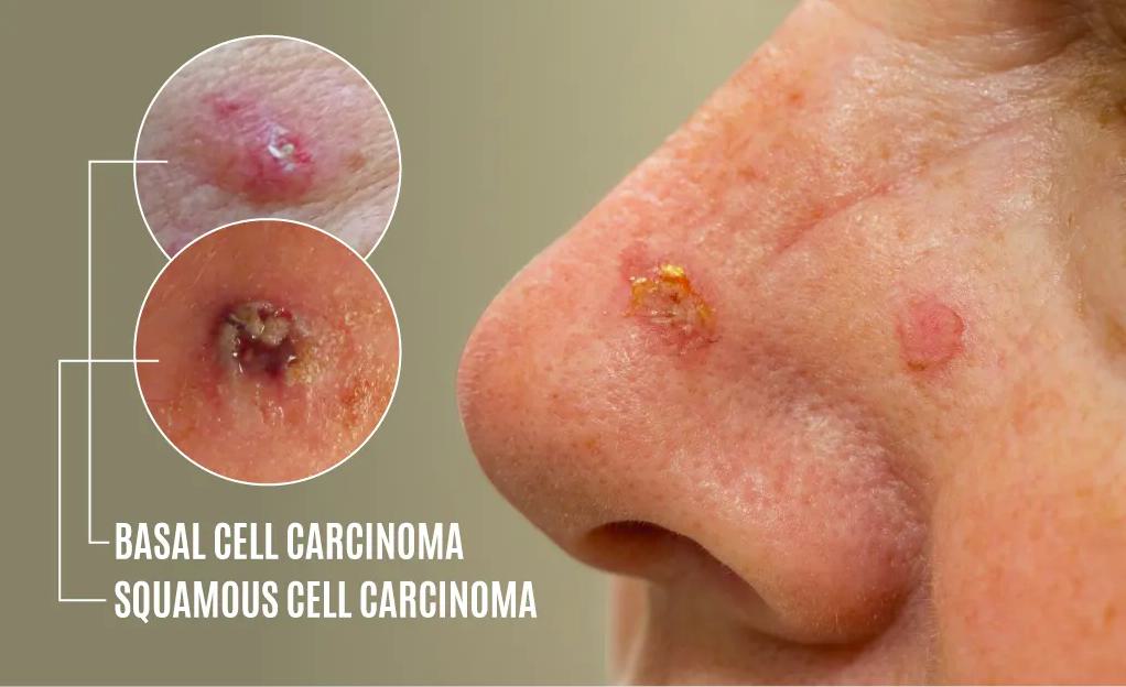 Non-Melanoma Skin Cancer: Causes and Risk Factors