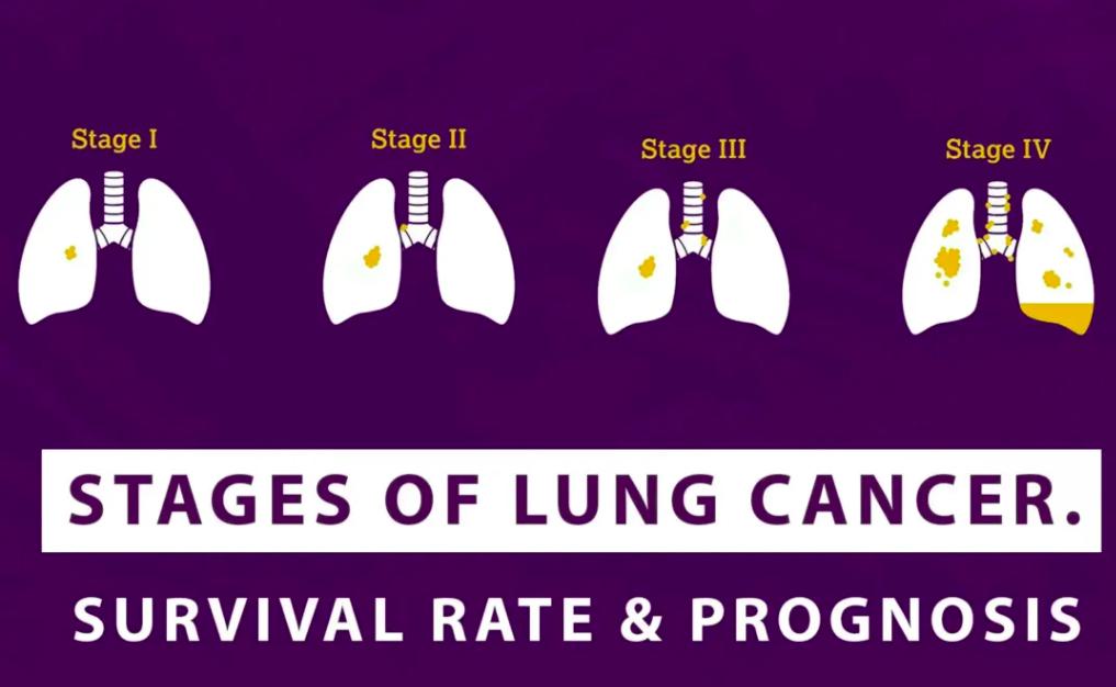 Stage 3 Lung Cancer Prognosis: Causes and Risk Factors