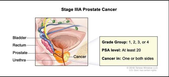Stage 3 Prostate Cancer Symptoms: Causes and Risk Factors