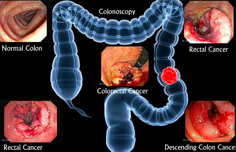 Test for Colon Cancer Without Colonoscopy: Causes and Risk Factors