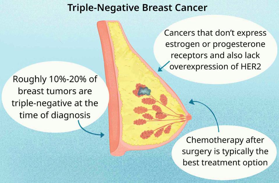 Triple Negative Breast Cancer Recurrence: Causes and Risk Factors