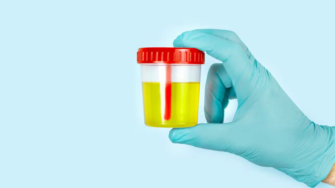 Urine Test for Prostate Cancer: Causes and Risk Factors